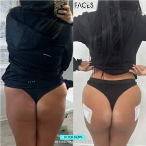 Brazilian Butt Lift (BBL)
