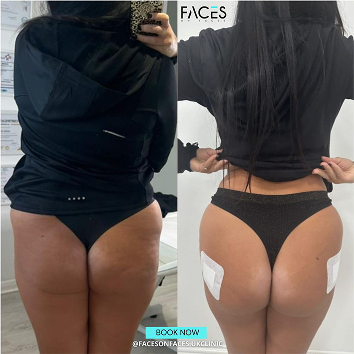 Brazilian Butt Lift (BBL)
