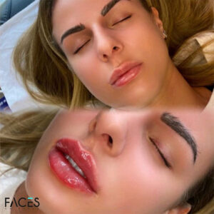 Lip Filler